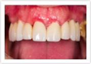 dental bridges after kent wa