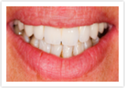 dental veneers after kent wa